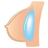 BCDOLL O02 山田花音 ピンク髪の爆乳アニメ美少女 ラブドール 155cm Jカップ シリコン製 エロ人形 かわいい